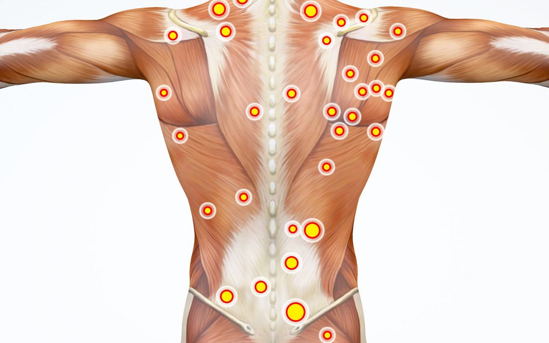 Trigger points on Body